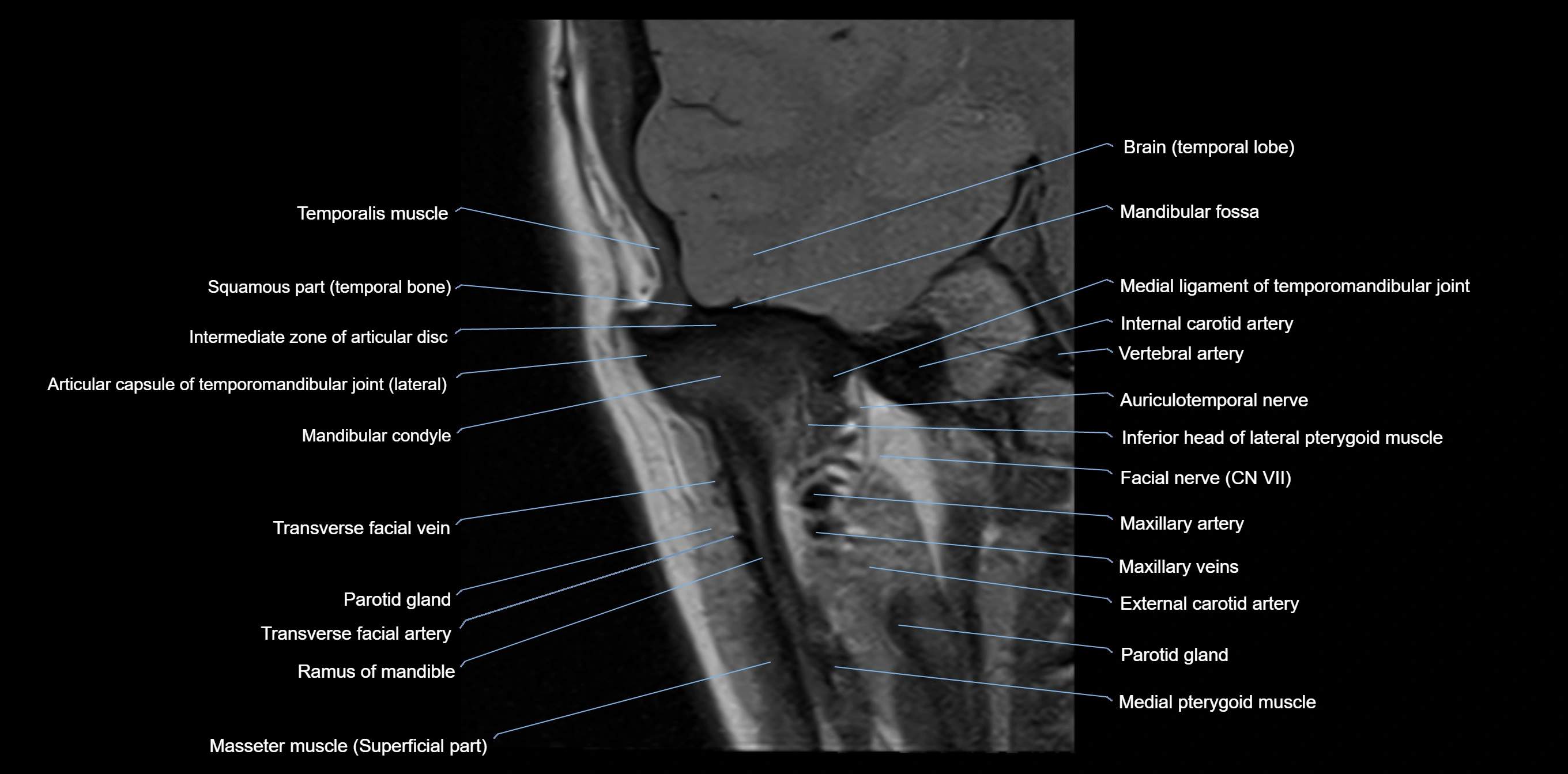 MRI TMJ coronal cross sectional 3T anatomy -img-00004-00006.webp